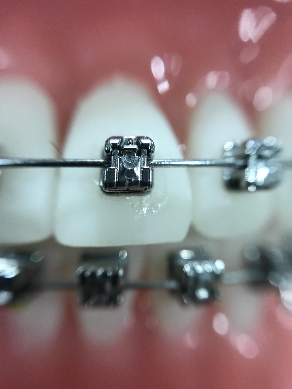 zoom, orthodontics, iphone, orthodontics, orthodontics, orthodontics, orthodontics, orthodontics