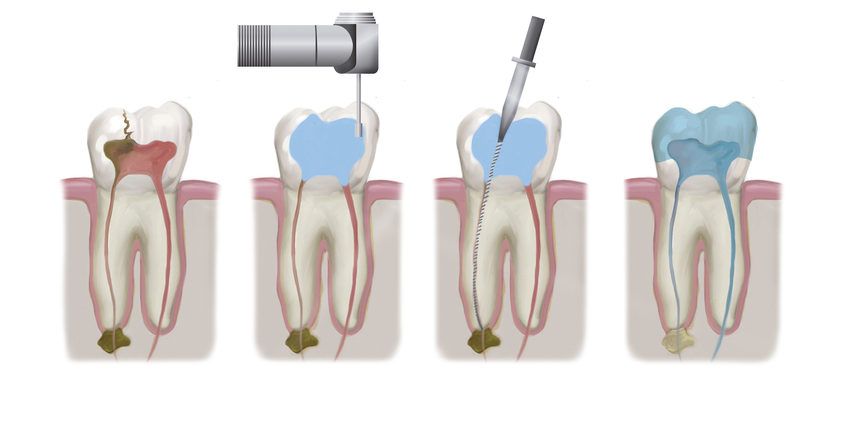 Valoración de endodoncia en Medellín