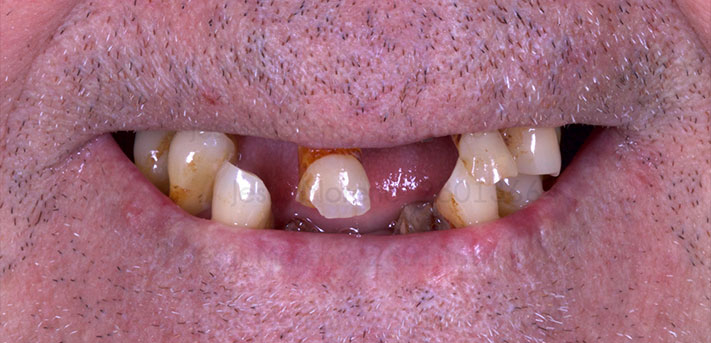 Valoración para implantes dentales en Medellín