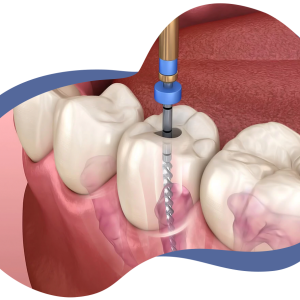 endodoncia