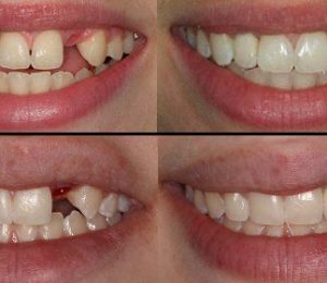 implantes dentales antes y despues