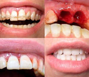 implantes dentales