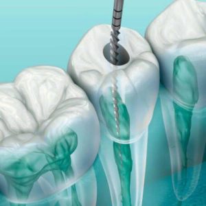 endodoncia