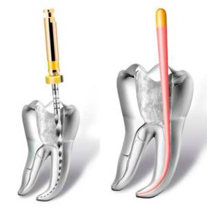 endodoncia1