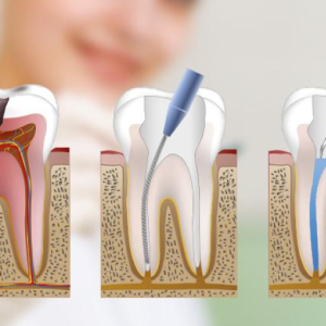 endodoncia2