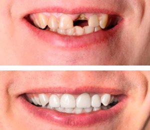 implante dental 6
