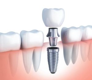 implantes