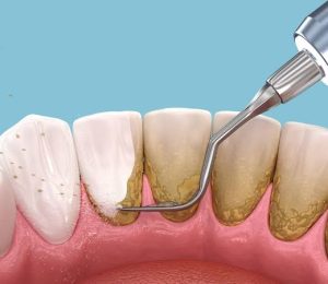 periodoncia1