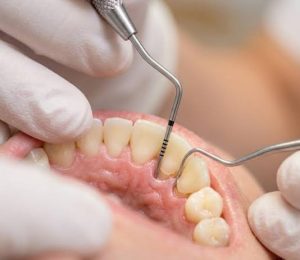 periodoncia2